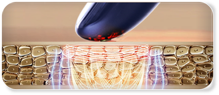 射频皮肤治疗仪(images 27)