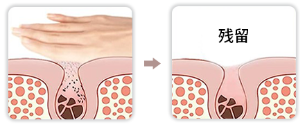 声波洁面仪（images 41）