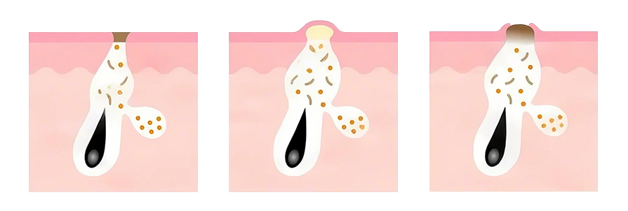 超声波铲皮机(images 10)